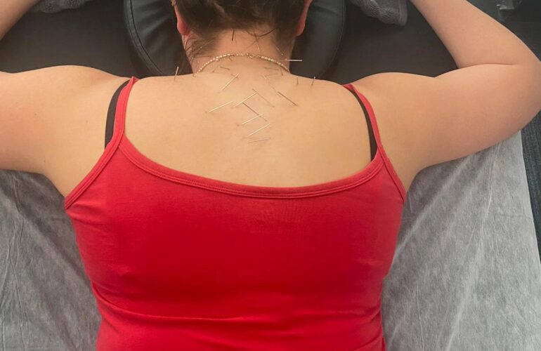 Dry Needling Therapy Mosman