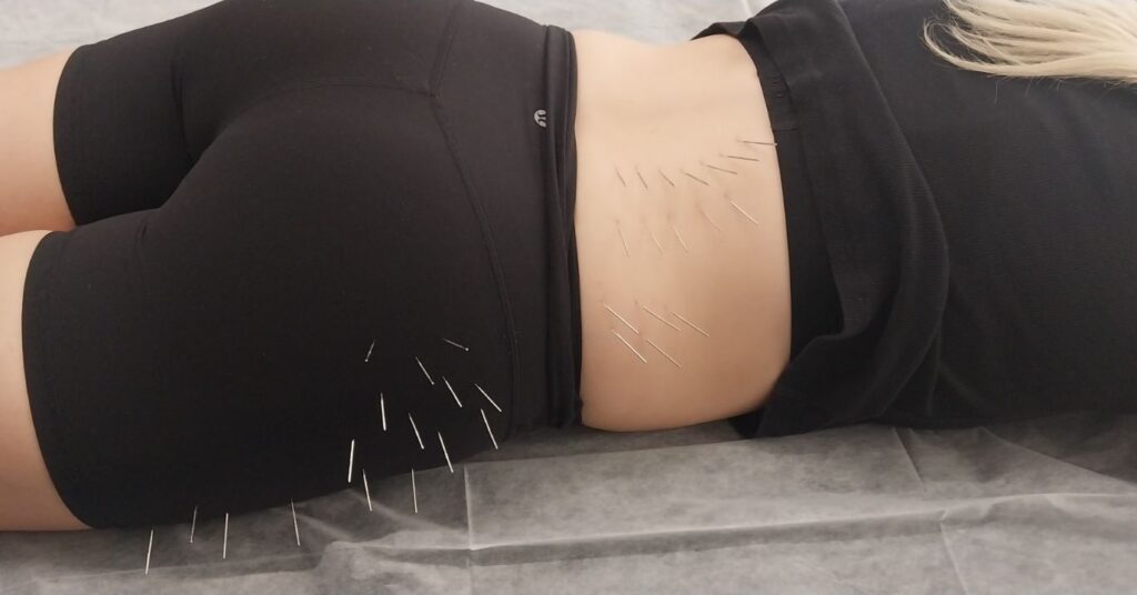 Dry Needling Therapy Mosman