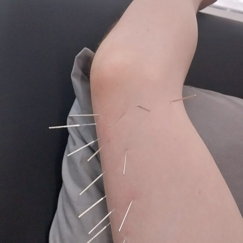 Dry Needling Therapy Mosman