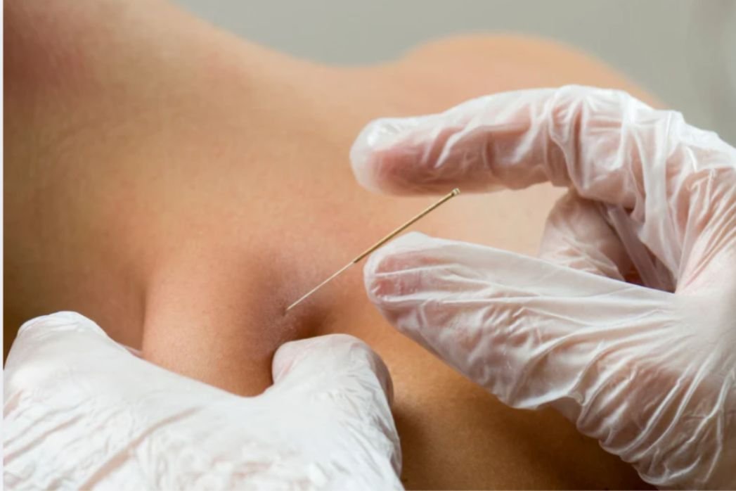 Dry Needling